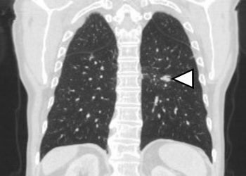 Kræftpatienter i Danmark har ikke lige adgang til behandling